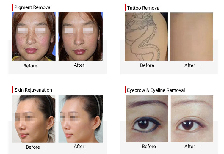 Picosecond ND YAG Laser Tattoo Removal/Beauty Equipment