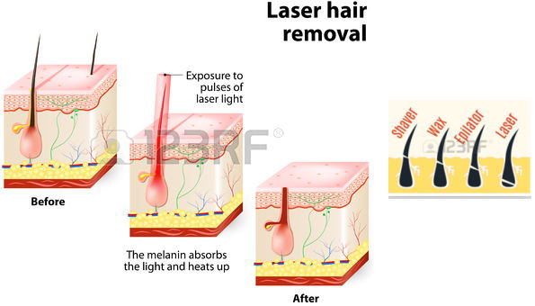 Hair Removal Diode Laser Machine Skin Depilation at Freezing Point Comfort