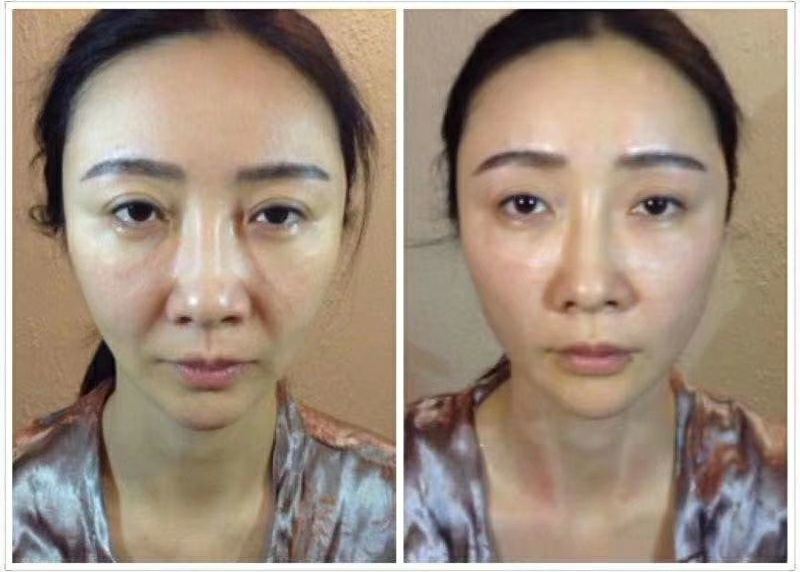 Hot 4D Hifu Facial Machine for Facelift Skin Tightening Anti-Aging