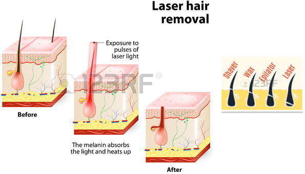 Portable IPL Equipment for Hair Removal