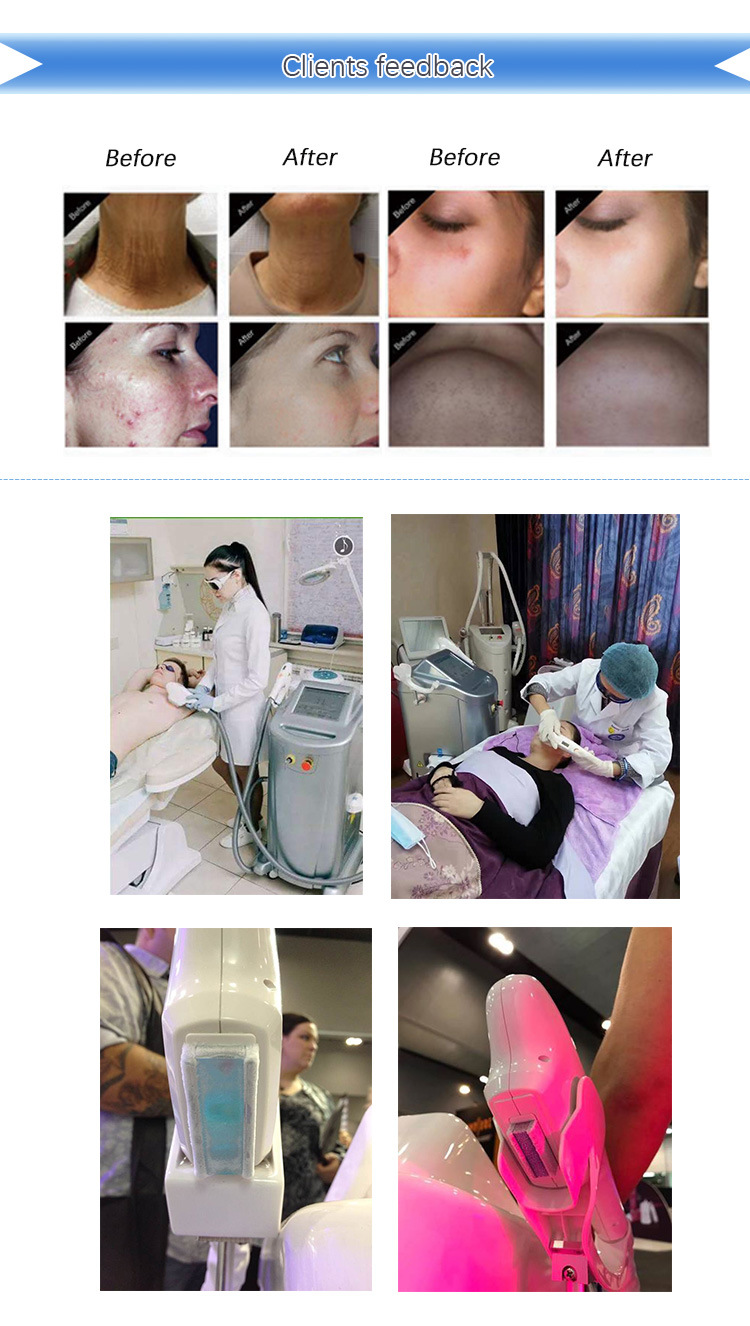 IPL Equipment Skin Rejuvenation Acne Treatment IPL Aesthetics Equipment