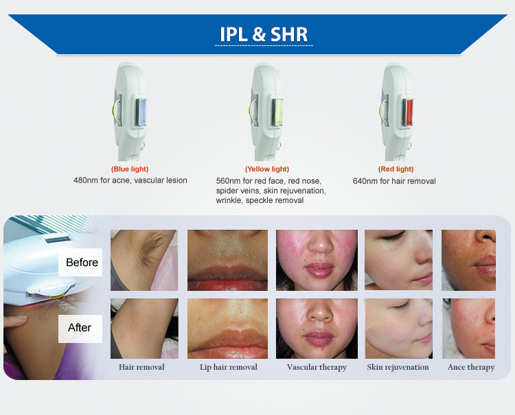 Professional IPL! ! ! Hair Removal, Skin Rejuvenation, Acne Removal IPL Hair Removal / Multifunctional Laser IPL Beauty