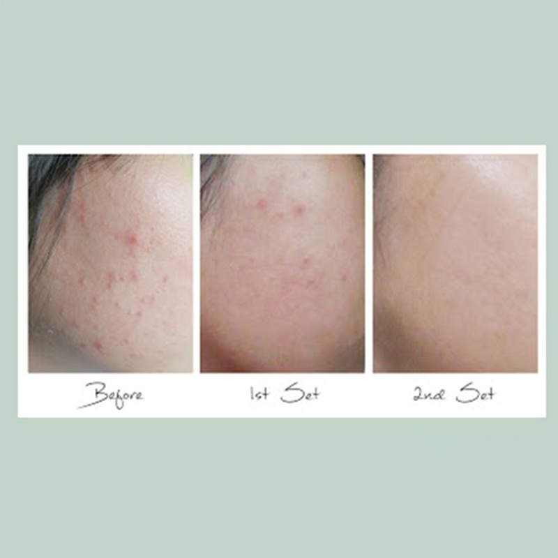 Acne Scar Removal Cleanser Acne Treatment Face Wash Skin Care Acne