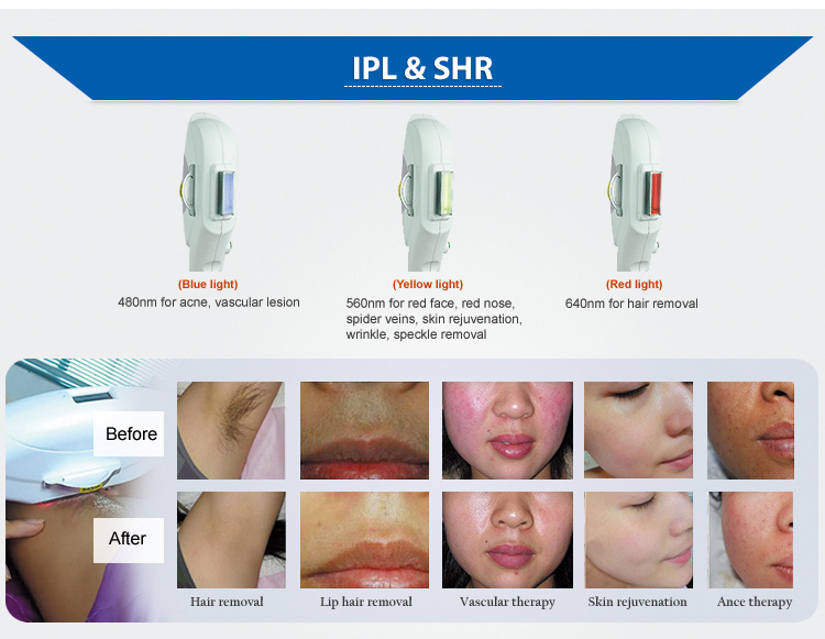 IPL Shr Elight Hair Removal and Skin Rejuvenation Machine