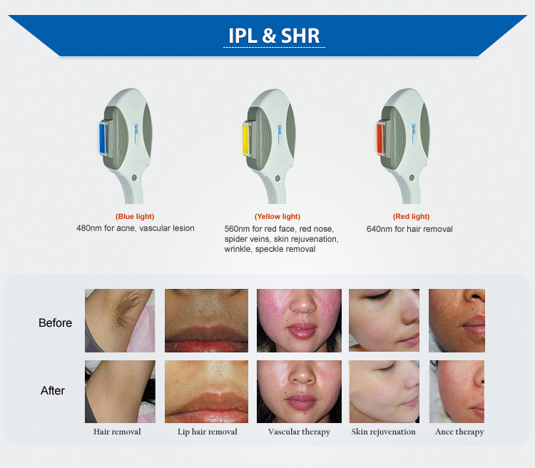 Opt/IPL Shr Machine for Rapid Permanent Hair Removal