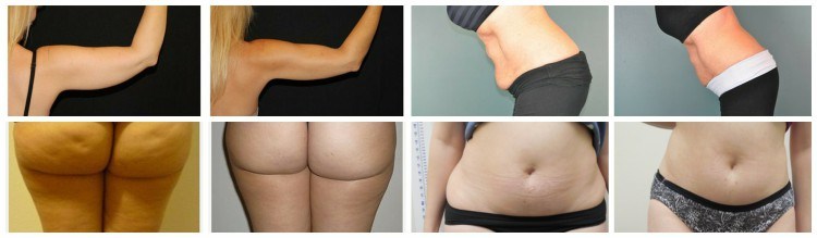 5D Hifu Body Slimming Machine Liposonix Weight Loss Beauty Equipment