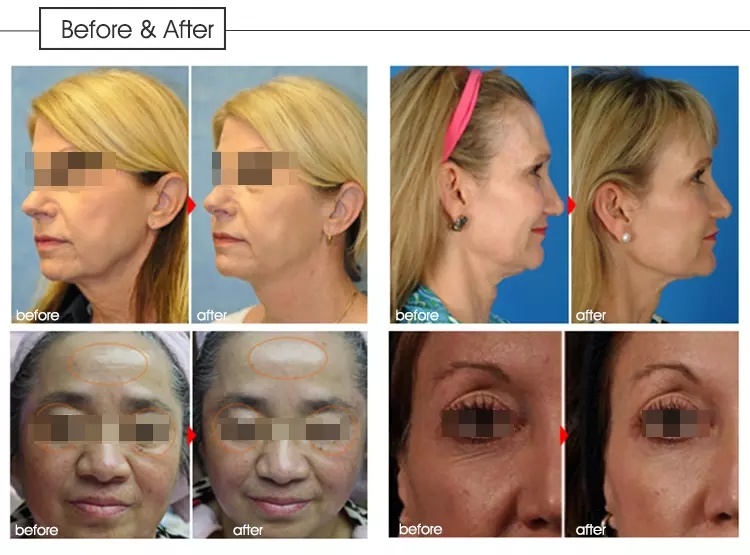 Salon Use High Intensity Hifu Ultrasound for Hifu Face Lift