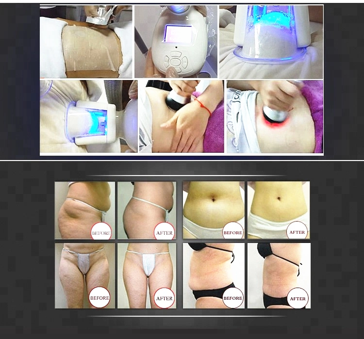 Cryolipolysis Vacuum Therapy Cooling Sculpting Fat Freezing Machine with Cavitation RF and Lipo Laser