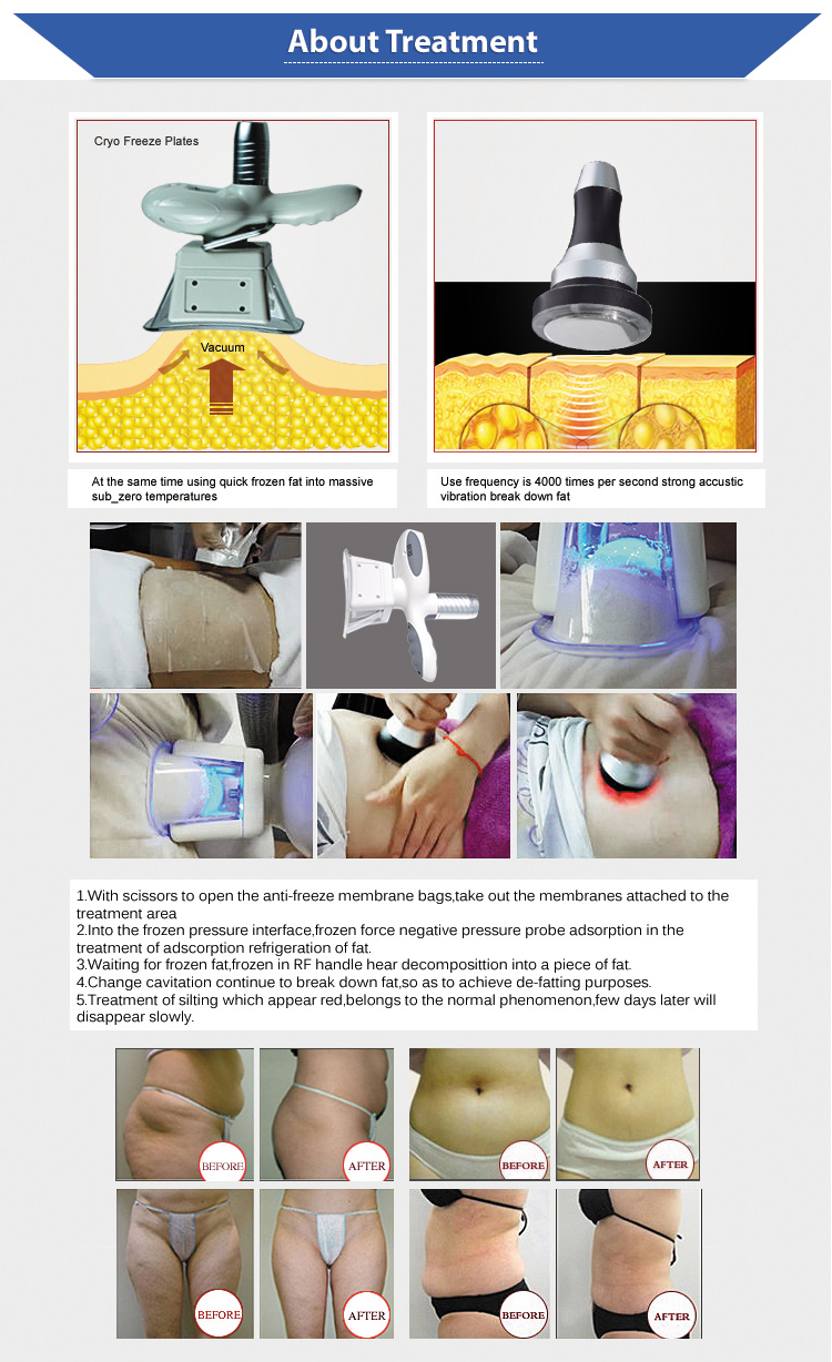 2020 Cryo Skin Lifting/ Tightening /Slimming Machine for Face and Body