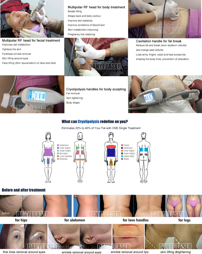Crioterapia Cavitation RF Body Slimming Machine