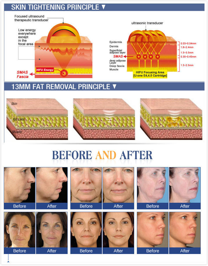 FDA Approved 3D Hifu Face Lifting Skin Tightening Machine Hifu Liposonix Machine