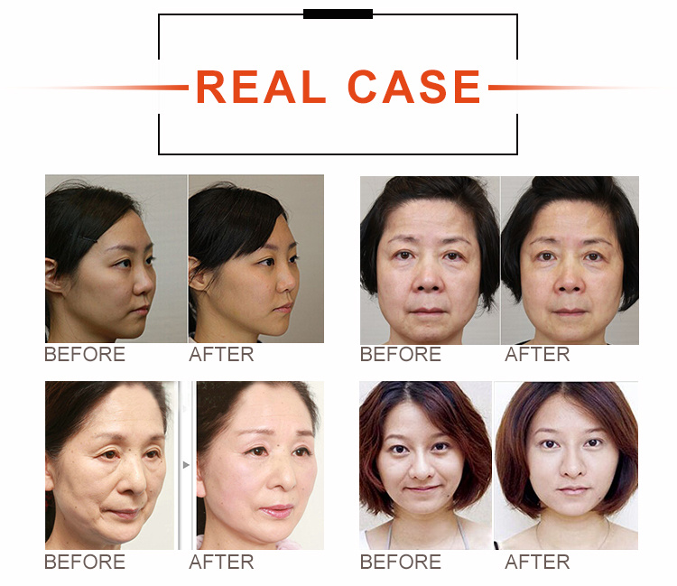 High-Grade Anti-Aging Hifu Beauty Equipment Ultrasonic Wrinkle Removal Machine