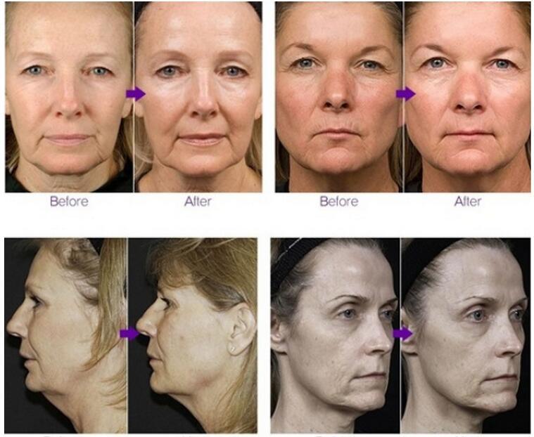 Anti-Aging Face Lift RF Anti-Wrinkle Beauty Machine
