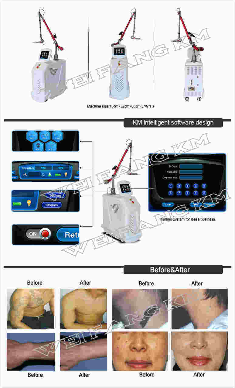 Q-Switch ND YAG Laser Painless Removal Tattoo Machine with Class 4 Laser