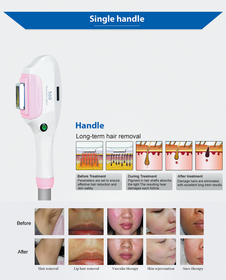 Portable IPL Elight/ Hair Removal IPL Machine for Sale