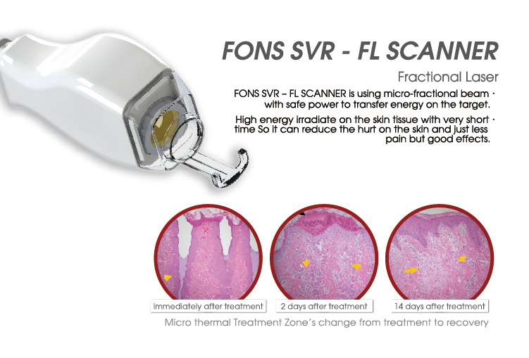 Surgical Fractional CO2 Laser Skin Resurface /Scar Removal
