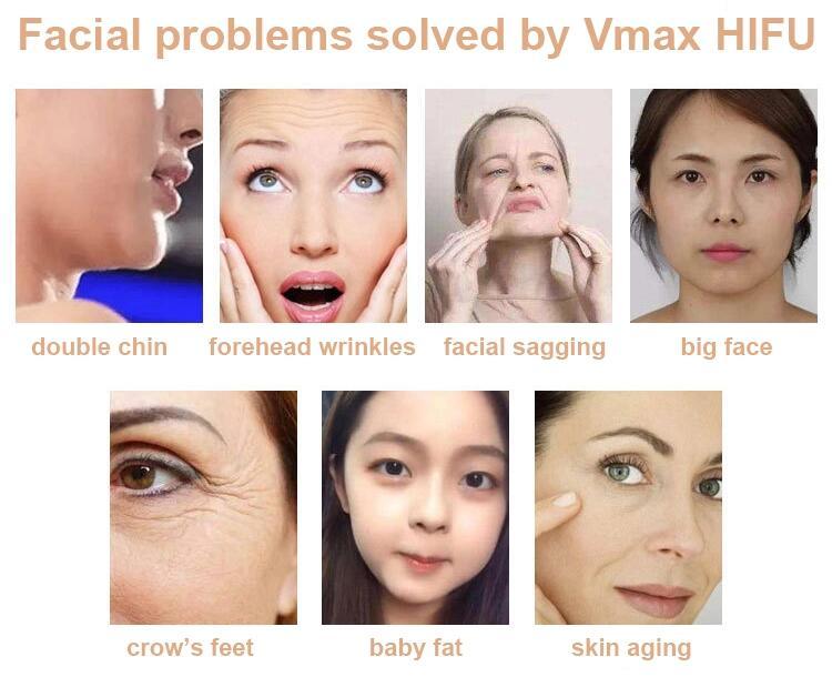 Korea V-Max Hifu Ultrasound Face Lifting Wrinkle Removal Machine