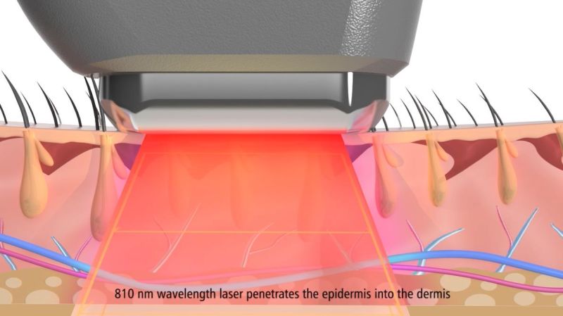 808nm Diode Laser Diode Laser/ Diode Laser Machine Painless, Permanent Depilation