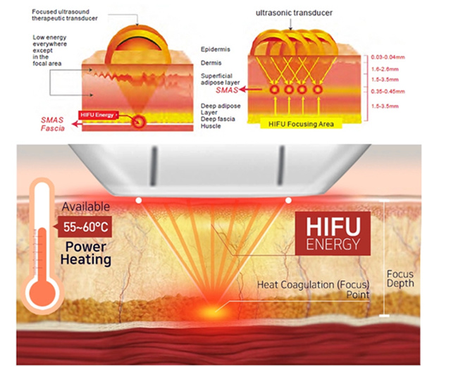 Portable Hifu Machine for Face Lift and Wrinkle Removal