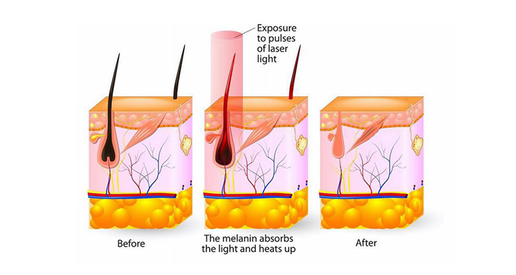 IPL Laser Hair Removal Depilation Machine