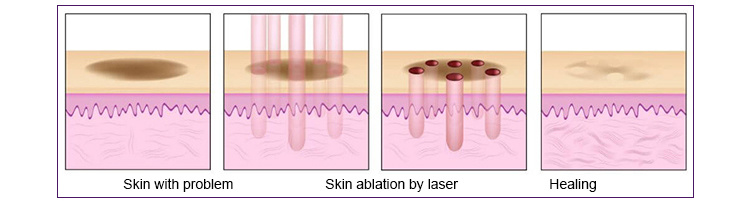 RF Fractional CO2 Laser Pigment Removal Equipment Fractional CO2 Laser Vaginal Rejuvenation
