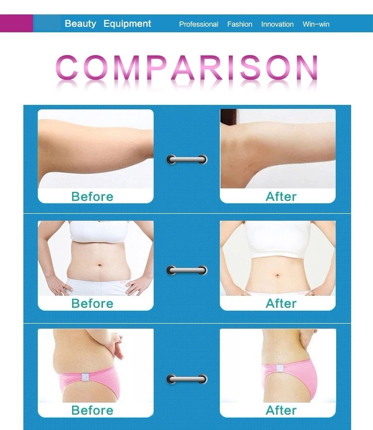 Professional Liposuction Hifu Liposonix Body Slimming Machine for Sale