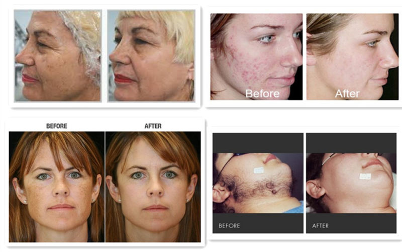 Multifunctional Facial & Body Treatment Shr IPL Equipment