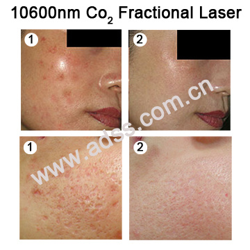 Fractional CO2 Laser System /Acne Removal Machine/Acne Treatment (FG900)