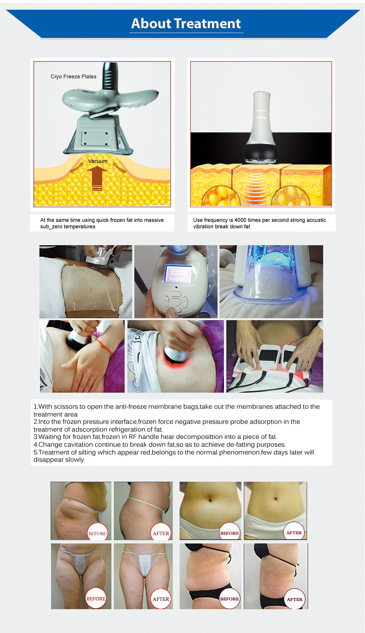 Ce Approved Weight Loss Cavitation Machine Cryolipolysis Laser Lipo Equipment