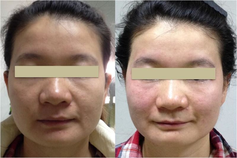 RF Acne Treatment Wrinkle Removal Beauty Machine