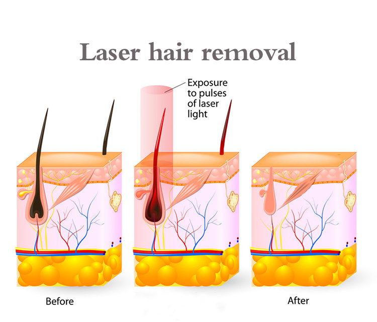 Rapid Hair Removal Diode Laser Portable 808nm Laser Machine
