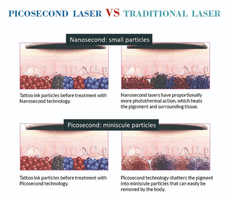 Picosecond Laser 755 ND YAG Laser Tattoo Removal Machines