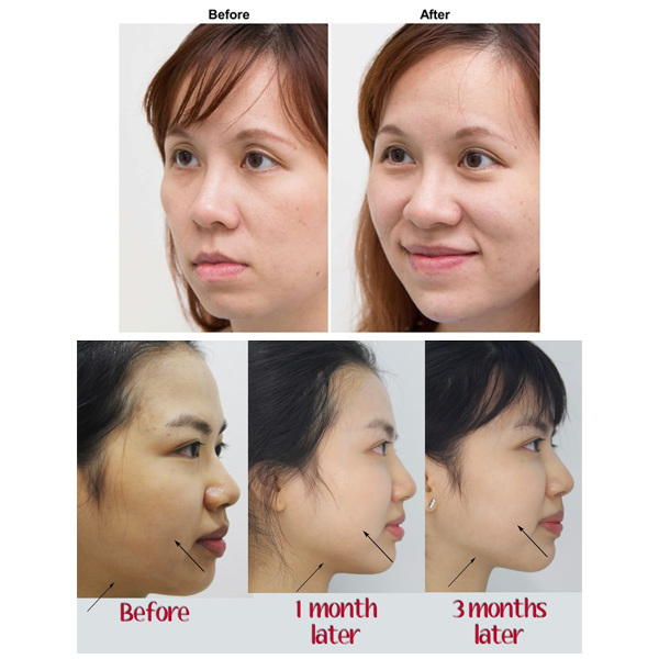 Portable Vmax Smas Face Lifting Anti Wrinkle 4D Hifu Machine