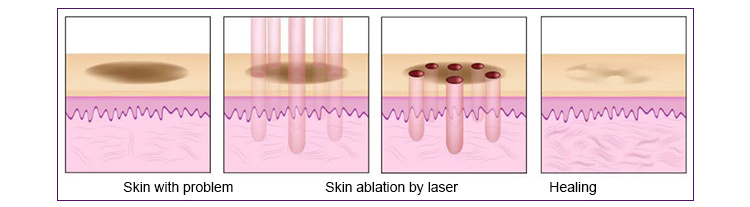 Portable Medical Skin Resurfacing Fractional Laser CO2 Machine