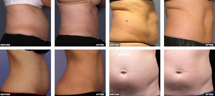 Professional Hifu Slimming Machine with Obvious Result