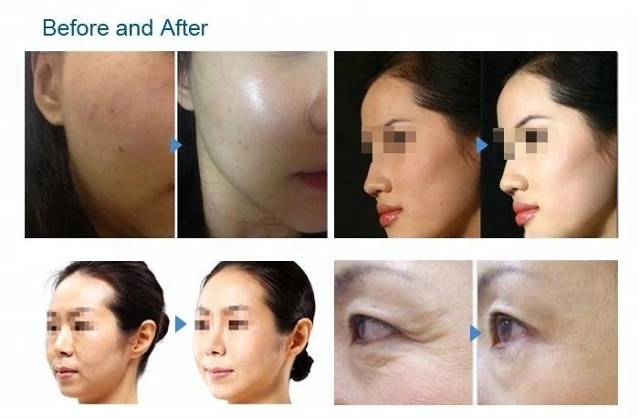 Hydra Aqua Peeling Microdermabrasion Facial Hydr Machine