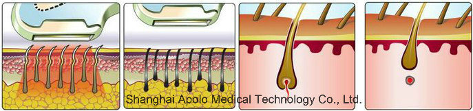 Apolo IPL Laser IPL Hair Removal Machine Shr IPL Hair Removal Machine Pain Free