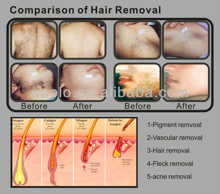 IPL Hair Removal Skin Rejuvenation Beauty Machine (HS-650)