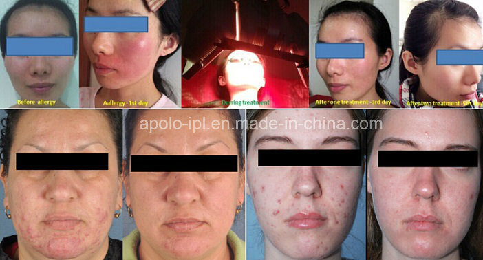 Ce Approval PDT LED Acne Removal Beauty Machine