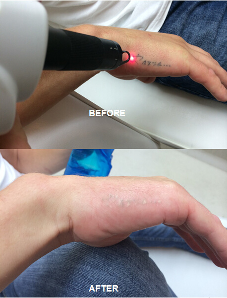 Good Feedbacks Laser Tattoo Removal Q-Switch ND YAG Laser Beauty Device