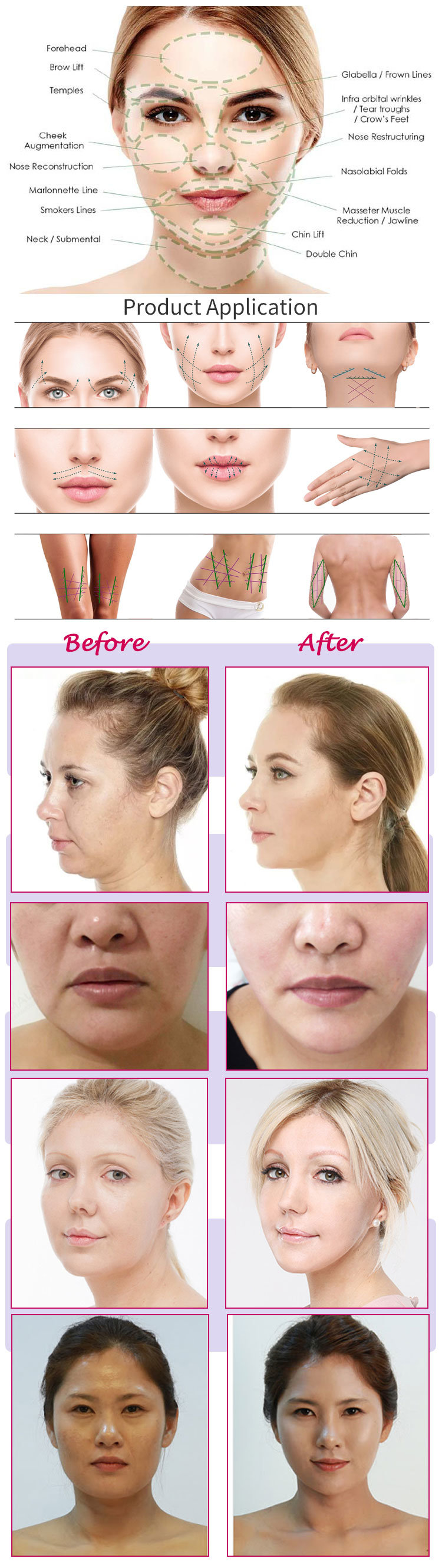 Anti-Wrinkle Miracu Face Lifting Thread Pdo Mesh for Beauty Use
