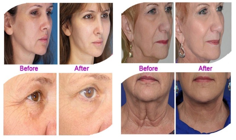 4 in 1 Vmax Hifu Face Lifting Skin Tightening Iontophoresis Facial Machine