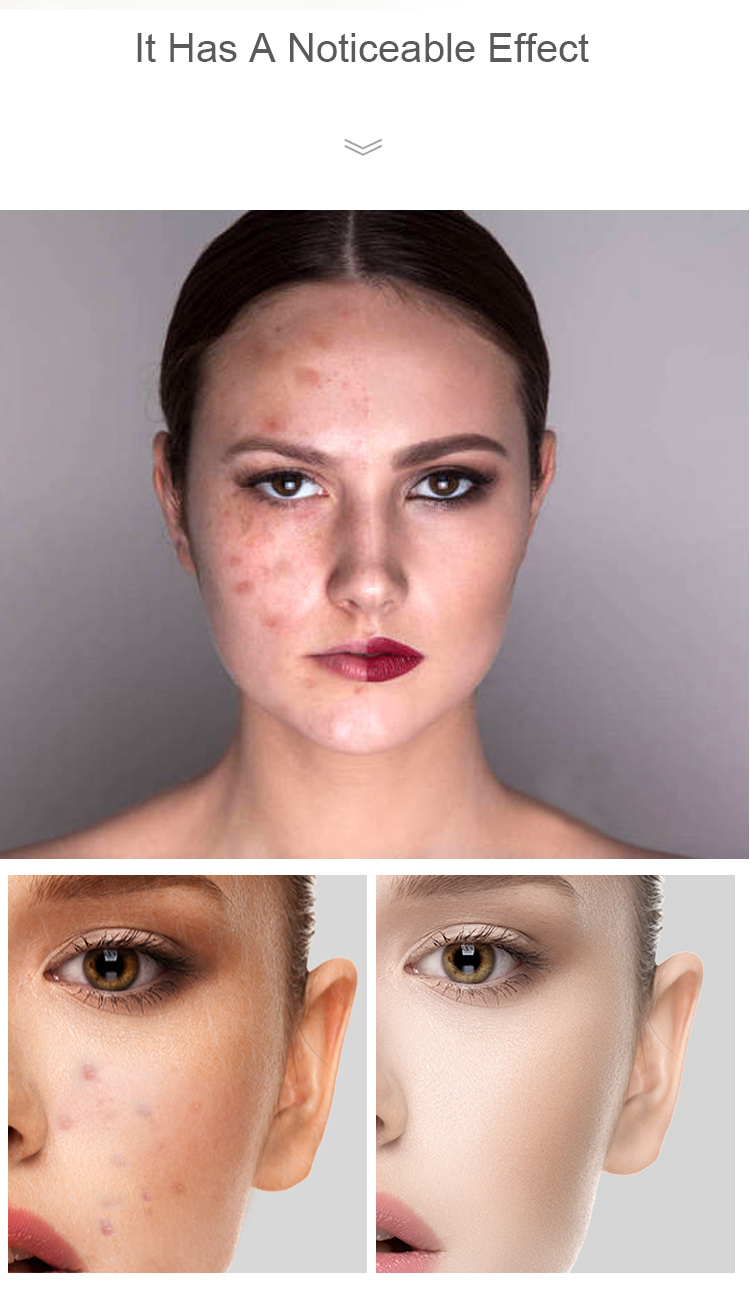 Private Label OEM Acne Treatment Serum Serum Blackhead Remover Skin Care Treatment Acne Skin Serum
