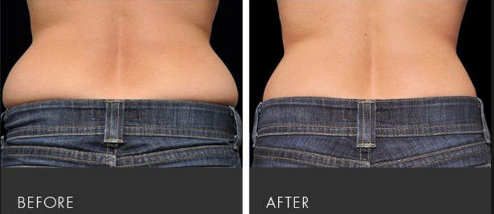 Hifu Liposonix Fat Reduction Hifu Beauty Machine for Body Slimming