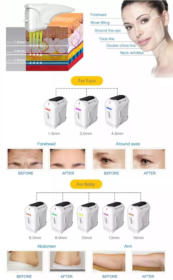 Sunwin Machine 2020 Face Hifu Skin Tightening Machine Hifu Vaginal Face Body 4D Hifu Anti-Wrinkle Machine