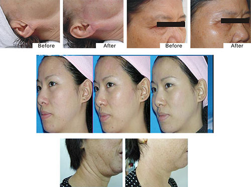 Beauty RF Wrinkle Reduction Anti Aging Beauty Machine