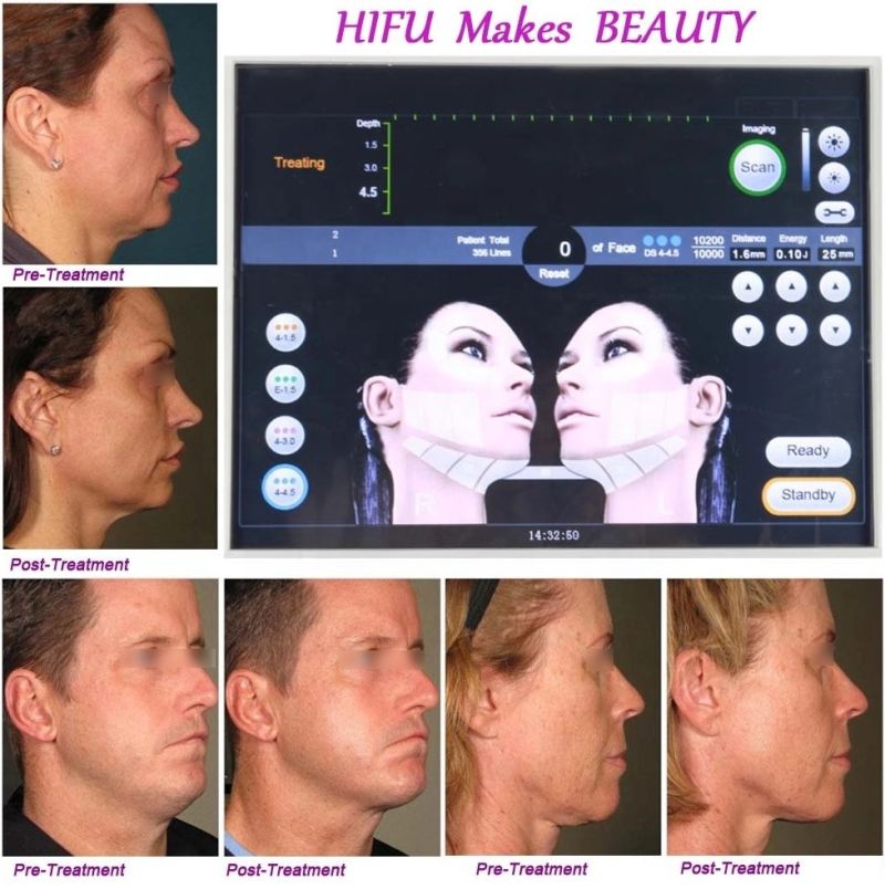 Trolley Hifu Ultrasound Machine Face Lifting Fat Removal for Sale