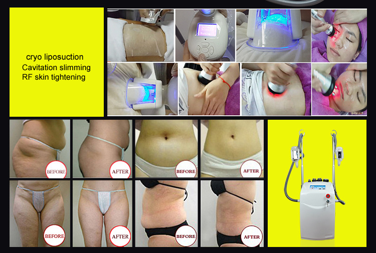 Portable Beauty Equipment Cryolipolysis Machine Fat Freezing Device Home Use for Body Slimming