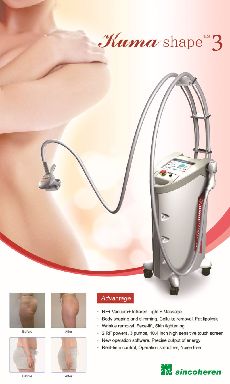 Body Shaping and Stretch Marks Removal Kuma Shape Device
