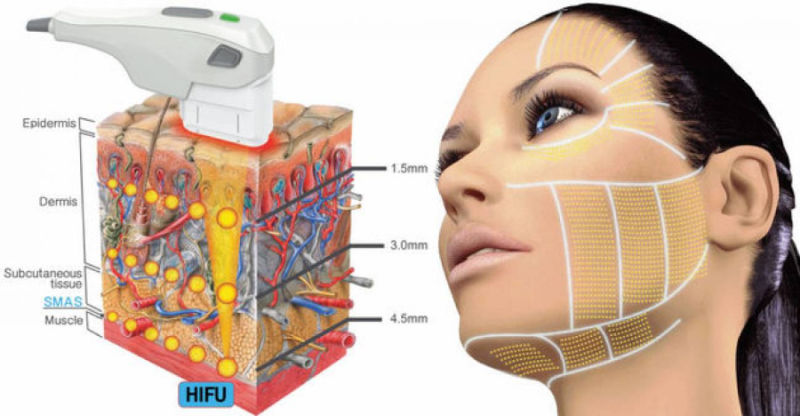 Professional Medical Korea Smas Hifu Facial Lifting Machine